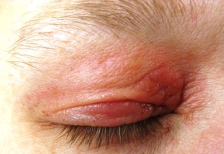 eczéma des paupières eczéma des paupières