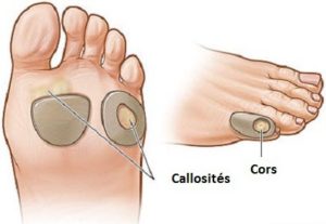 rem-des-maison-pour-enlever-le-cal-et-la-corne-sous-les-pieds