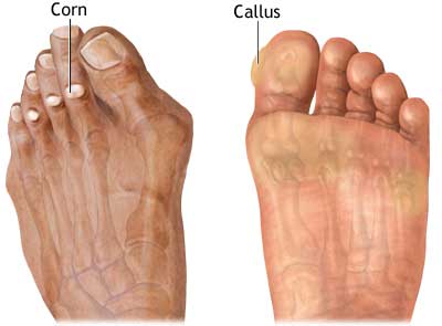 enlever les peaux mortes des pieds enlever les peaux mortes des pieds