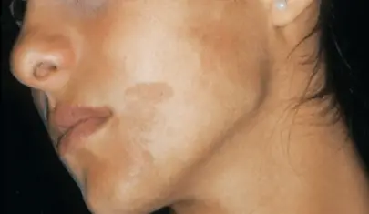 photo des taches brunes sur le visage photo des taches brunes sur le visage