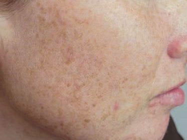 taches brune sur le visage taches brune sur le visage