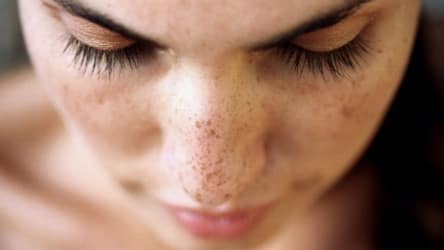 taches brune sur le visage