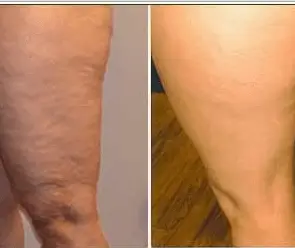 Anti-Cellulite Maison