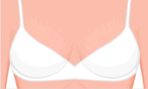 vergetures sur les seins