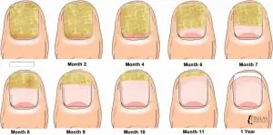 mycose des ongles de pieds traitement efficace mycose des ongles de pieds traitement efficace