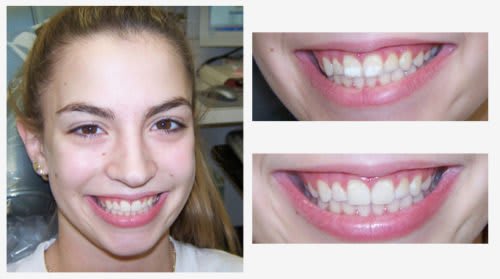 taches blanches sur les dents taches blanches sur les dents