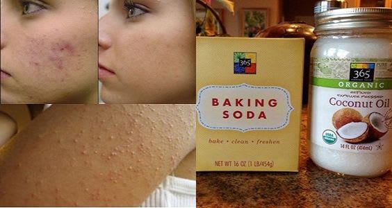 bicarbonate de soude contre l'acné et les boutons bicarbonate de soude contre l'acné et les boutons