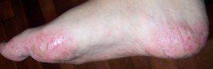 Dyshidrose des Pieds et des Mains Dyshidrose des Pieds et des Mains