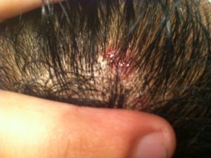 Croutes Du Cuir Chevelu Causes Et 5 Remedes Efficaces