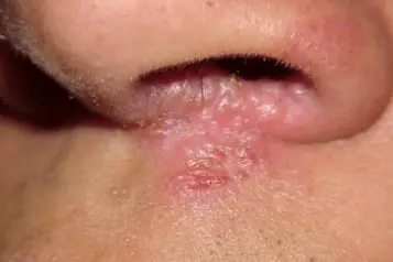 croûte dans le nez croûte dans le nez