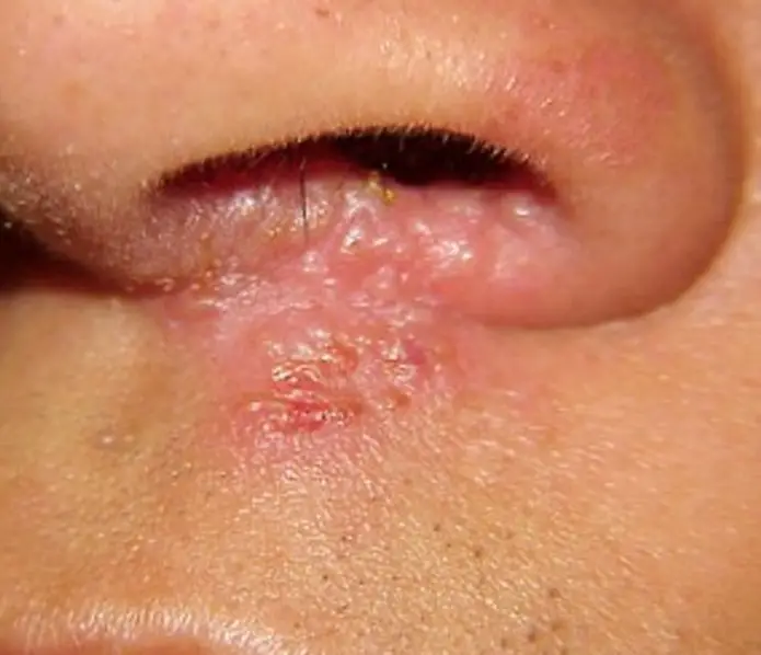 staphylocoque dans le nez