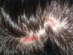 lupus lupus