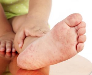 eczéma dysidrosique eczéma dysidrosique