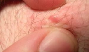 poils incarnés sur les jambes poils incarnés sur les jambes