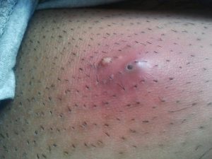 acné sur les jambes acné sur les jambes