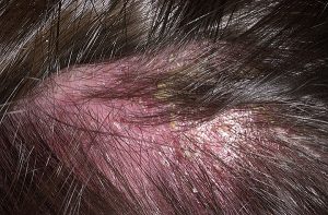 psoriasis ou eczéma sur la cuir chevelu psoriasis ou eczéma sur la cuir chevelu