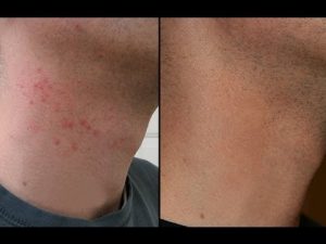 Boutons Après le Rasage : Comment Les Éliminer (3 Méthodes ... Boutons Après le Rasage : Comment Les Éliminer (3 Méthodes ...