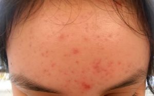 Boutons sur le Front (Petits et Gros) : 10 Remèdes Faciles ... Boutons sur le Front (Petits et Gros) : 10 Remèdes Faciles ...