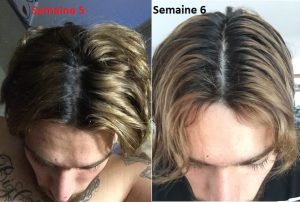 forcapil avant après