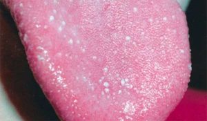 Traiter Les Boutons Sur La Langue 12 Remedes Efficaces