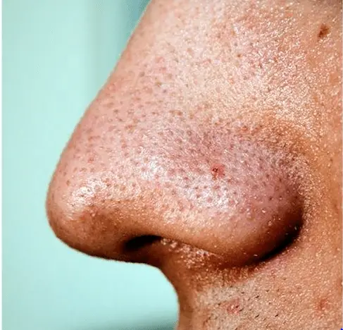 points noirs sur le nez