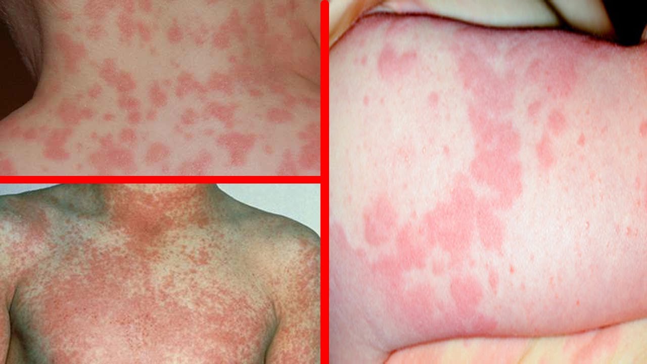 Plaques Rouges sur le Corps 12 Remèdes Naturels [13 Causes]