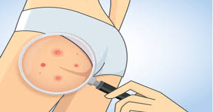 causes des boutons sur les fesses des femmes