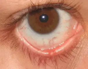 bouton blanc sur l’œil de votre paupière inférieure bouton blanc sur l’œil de votre paupière inférieure