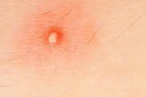 bouton rouge sur le sein bouton rouge sur le sein
