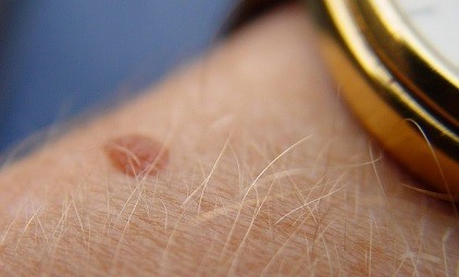 grain de beauté douloureux au toucher
