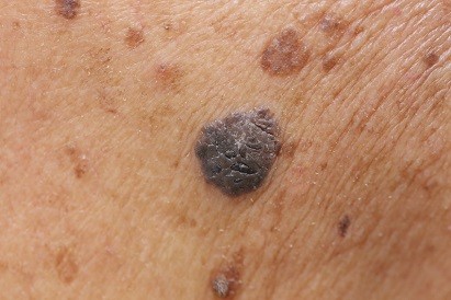 Grain De Beauté Qui Gratte 5 Causes Diagnostic Signes Du