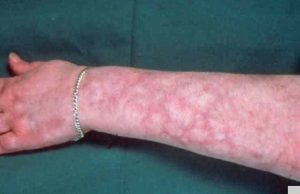 peau marbrée sur les bras peau marbrée sur les bras