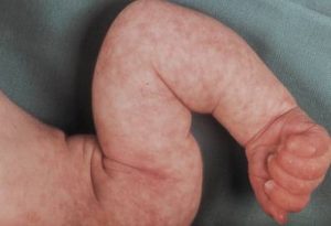 peau marbrée du bébé peau marbrée du bébé