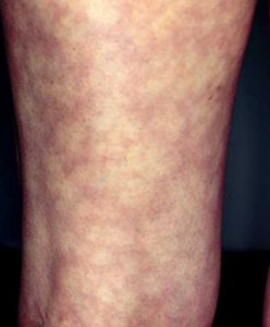 peau marbrée sur les jambes peau marbrée sur les jambes