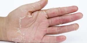 peau qui pèle sur les mains peau qui pèle sur les mains