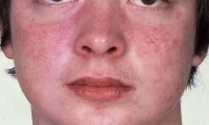 traiter les plaques rouges du visage traiter les plaques rouges du visage