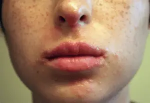 boutons sur coin de la bouche boutons sur coin de la bouche
