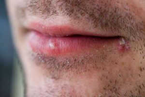 boutons sur les lèvre de la bouche boutons sur les lèvre de la bouche