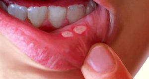 boutons blancs dans la bouche boutons blancs dans la bouche
