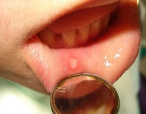 boutons dans la bouche boutons dans la bouche