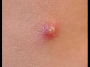 bouton derrière la nuque bouton derrière la nuque
