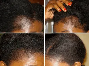 huile de ricin pour cheveux crépus : avant et après huile de ricin pour cheveux crépus : avant et après