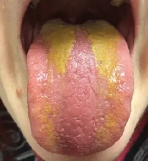 langue jaune langue jaune