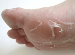 Peau Qui Pele Sur Les Mains Et Les Pieds Causes Et Remedes Efficaces