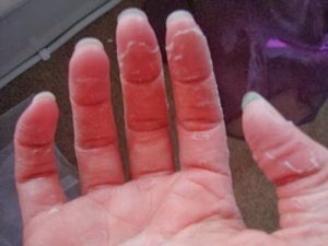 peau qui pèle sur les doigts peau qui pèle sur les doigts