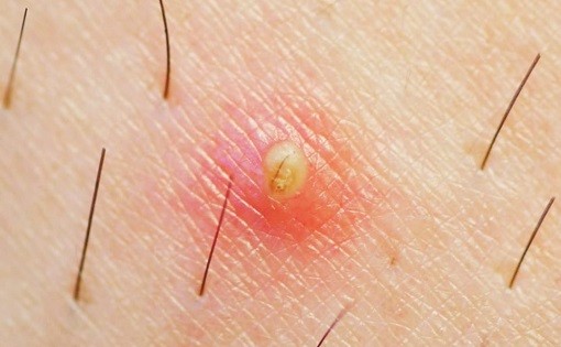 comment enlever les poils incarnés infectés