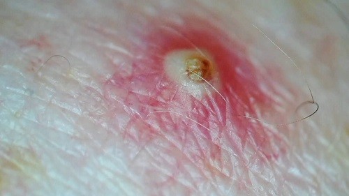 Comment Enlever les Poils Incarnés Infectés (boule de pu)