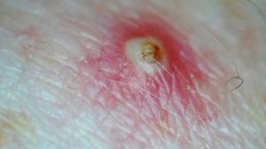 poils incarnés infectés poils incarnés infectés