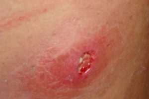poils incarnés infectés comme boule de pus poils incarnés infectés comme boule de pus