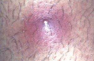 poils incarnés infectés du jambe poils incarnés infectés du jambe